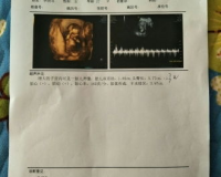 双顶径1.85