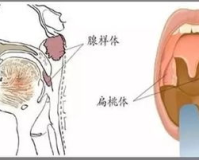 腺样体1.76,腺样体肥大，指咽扁桃体增生