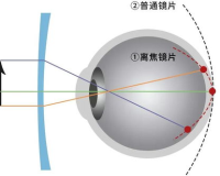 1.76的镜片750度,1.76镜片750度:与重量无关，让眼睛自由呼吸