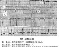 建议:房性早搏1.76，疾病信号正常吗?